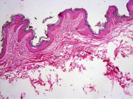 Гистологическая картина, демонстрирующая папилломатоз.